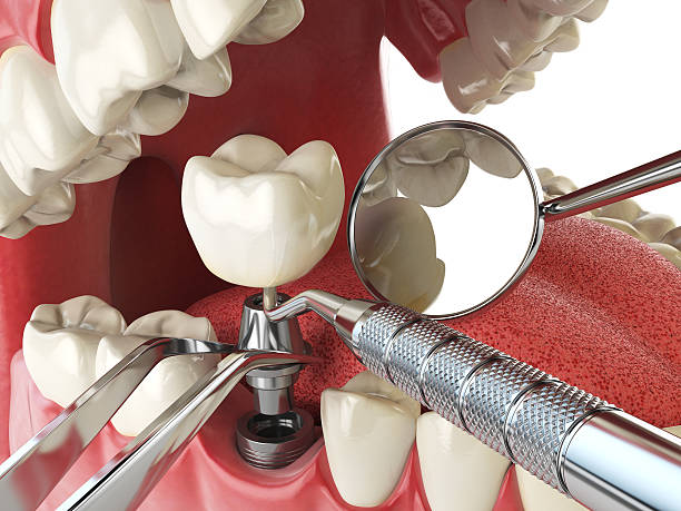 Best Emergency Root Canal Therapy in Bon Secour, AL