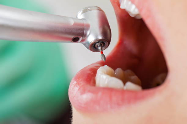 Best Dental Abscess Treatment in Bon Secour, AL
